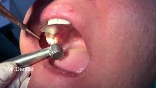 Endodontic Treatment Of A Molar With A Partially Necrotic Pulp! - Mortal Method    !!!!