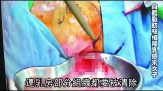 抽脂隆乳 雙峰發炎噴巧克力膿-蘋果日報