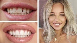 HOW I FIXED MY TEETH ON A BUDGET | Lucy Jessica Carter