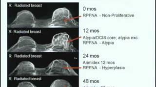 "Good Breast Gone Bad: Lessons Learned in Risk Stratification of Mammary Atypia"