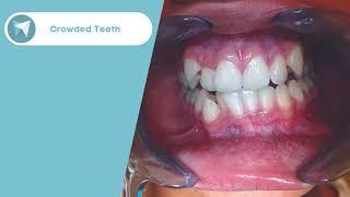 Crowded Teeth Treatment Before / After - Forest & Ray - Dentists, Orthodontists, Implant Surgeons