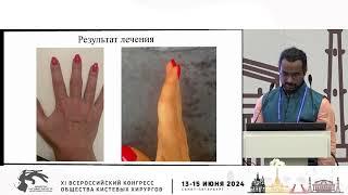 Дас С.: лечение закрытых переломо-вывихов основания средней фаланги пальцев c помощью Suzuki Frame.