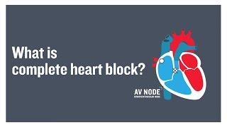 What is complete heart block?