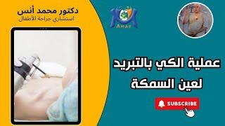 خطوات عملية الكي بالتبريد لعين السمكة / دكتور محمد أنس