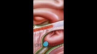 Hernia Repair Inguinal (Open) Surgery PreOp® Patient Education & Patient Engagement #shorts