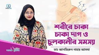 শরীরে চাকা চাকা দাগ ও চুলকানীর সমস্যা Urticaria - Causes, Symptoms, and Treatment