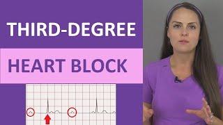 Third-Degree AV Heart Block ECG Nursing Rhythm NCLEX | Complete Heart Block