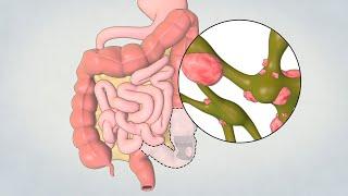 Patient Teaching: Left Hemicolectomy/ Sigmoid Colectomy | TVASurg