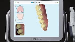 iTero® Scanner Tutorial: Charting and Scanning for an Implant