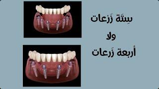 ازاي احدد عدد الزرعات المطلوبة لكل فك؟ ٤ ولا ٦ ولا حتي ٨ زرعات؟