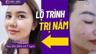 Sự thật về Trị Nám tại các cơ sở thẩm mỹ | HỆ THỐNG THẨM MỸ QUỐC TẾ LINH ANH