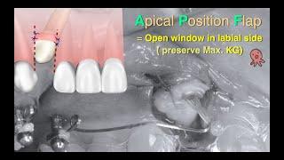 Apical position flap design for exposing upper impacted canine in aligner treatment｜【CC Ortho】CC705