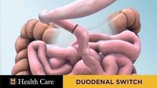 Bariatric Surgery Seminar: Duodenal Switch