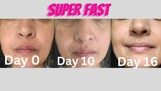 BOMB 15-day fading skincare routine to remove TAN, blemishes, hyperpigmentation, acne scars, melasma
