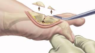 Arthritis of the Big Toe: Diagnosis and Treatment at Holy Cross Orthopedic Institute