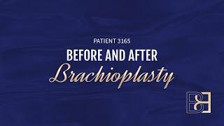 Brachioplasty (Arm Lift) Post Weight Loss {Patient 3165} Before & After