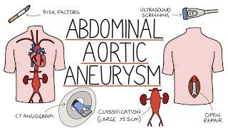 Understanding Abdominal Aortic Aneurysms