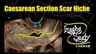 Caesarean Section Scar Niche || Ultrasound || TVS || Case 297