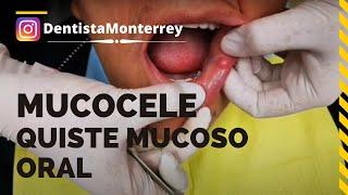 MUCOCELE - QUISTE MUCOSO BUCAL  DentalTip