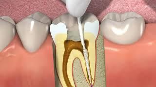 Як зробити лікування каналів зуба
