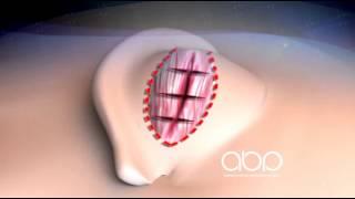 Otoplasty - 3D Medical Animation || ABP ©
