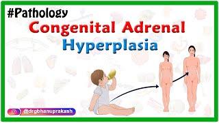 Congenital adrenal hyperplasia : Etiology ,Pathophysiology ,Clinical features ,Diagnosis ,Treatment