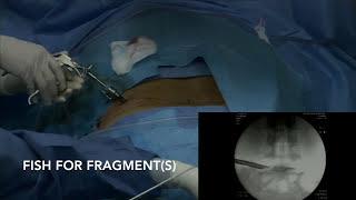 Endoscopic Spine Surgery | YESS HNP End Plate Fragment