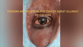 Best artificial eye fitting and best artificial eye maker in Surat Gujarat 8511211696