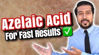 Azelaic Acid for Melasma | How to Use Azelaic Acid for SUCCESS 