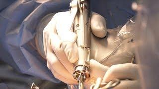 Watch knee replacement using the MAKO Robotic arm