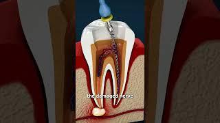 What Is A Root Canal? 