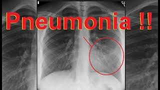 مظهر ذات الرئة على صورة الصدر | How to detect pneumonia on CXR ?