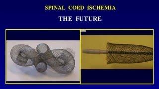 UCSF Vascular Surgery Symposium - Spinal Cord Ischemia After Thoracic Aneurysm