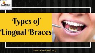 Different Types of Lingual BracesBest Smile makeover in Bangalore | Best Orthodontist in Bangalore|
