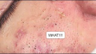 LOTS OF BLACKHEADS ON THE FACE   GREAT JOB GA SPA PART II #relaxing  #blackheads