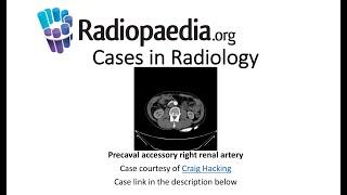 Precaval accessory right renal artery (Radiopaedia.org) Cases in Radiology