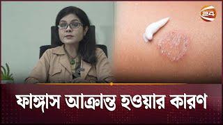 ফাঙ্গাস আক্রান্ত হওয়ার কারণ | Fungal Infection | Health Tips | Channel 24