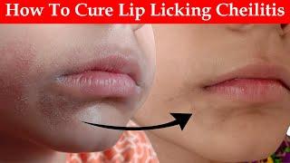 How To Cure Lip Licking Cheilitis?