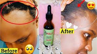 HOW I GREW BACK MY HAIRLINE/MIELLE ROSEMARY MINT OIL BEFORE AND AFTERMASSIVE HAIR GROWTH 