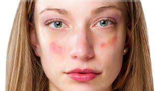 Treatment tips and prevention for acne | Line One