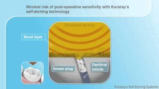 Kuraray Self-etch demonstration - dental use