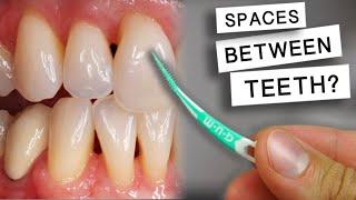 Do Floss Picks Cause Spaces Between the Teeth or Black Triangles?