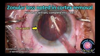 CataractCoach™ 2571: zonular loss noted in cortex removal