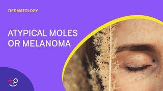Atypical Moles or Melanoma: The ABCDE's [Dermatology]