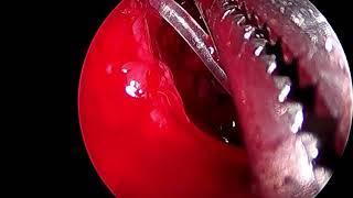 Endoscopic Dacryocystorhinostomy (DCR) Revision