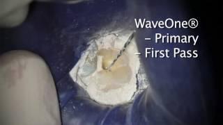 WaveOne® - Dr. Bill Nudera WaveOne® Case study | DENTSPLY