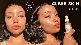 MY UPDATED SKINCARE ROUTINE | unsponsored skincare for acne