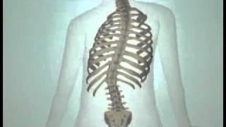 Teen Scoliosis Causes and Treatment Options- DePuy Videos