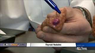 Thyroid Nodules