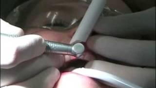 Child Dentistry - Cleaning out a cavity with the laser